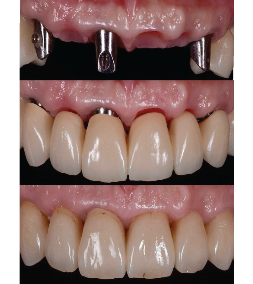 implantes